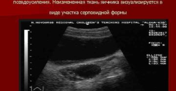 Анэхогенное образование возле яичника