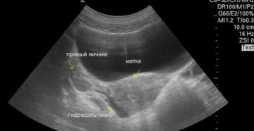 Можно ли забеременеть после гидросальпинкса?