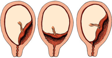 Низкое прикрепление хориона и выделения