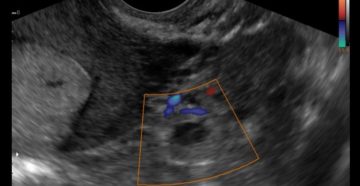 Видны ли проблемы с трубами по узи