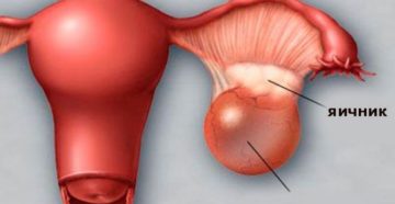 Повторно образовалась фолликулярная киста Повторно образовалась фолликулярная киста