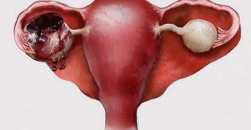 Боль после апоплексии