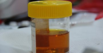 Темная моча и печень