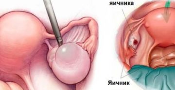 Боли в груди и киста левого яичника Боли в груди и киста левого яичника