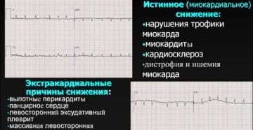 Экг. Снижен вольтаж