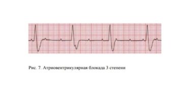 Синусовая тахикардия, высокое давление