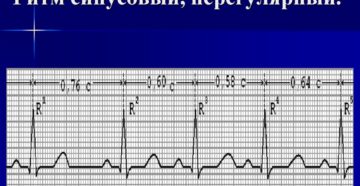 Тахисистолия, нерегулярный синусовый ритм