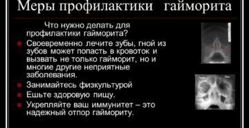 Рецидив гайморита и профилактика