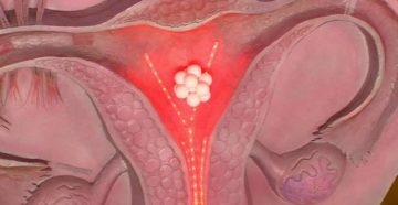 Задержка месячных после пункции