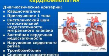 Кардиомегалия плода, кардиомиопатия