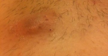 Гнойная шишка в зоне бикини