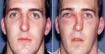 Баня после перелома носа Баня после перелома носа