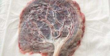 Патология последа