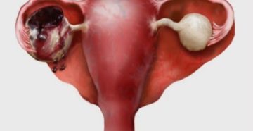 Киста яичника консультация