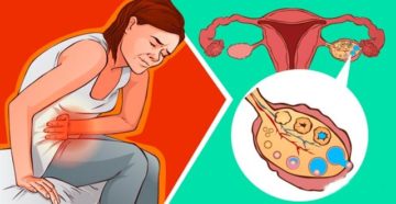 Задержка месячных 19дней и болит левый бок Задержка месячных 19дней и болит левый бок