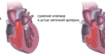 Стеноз легочной артерии