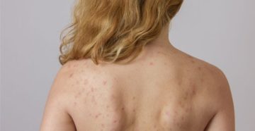 Появились болезненные прыщи на спине во время приёма Тайм фактор