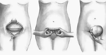 Можно ли заниматься оральными ласками после кесарева?