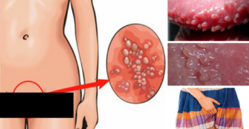 Зуд малых половых губ и входа во влагалище