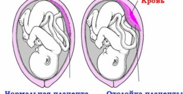 Отслойка плаценты на 7 неделе беременности