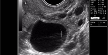 Эндометрий при поздней овуляции и аваскулярный фолликул Эндометрий при поздней овуляции и аваскулярный фолликул