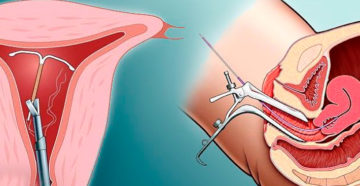 Кровотечение после удаления спирали Мирена