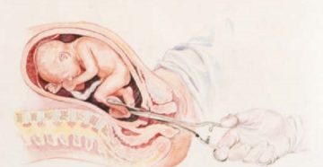 Беременность после искусственных родов