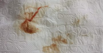 Кровавая мазня во время стимуляции Фоллитропом Кровавая мазня во время стимуляции Фоллитропом