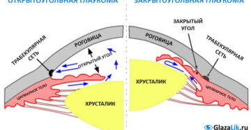 Нозальные при открытоугольной глаукоме