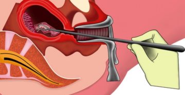 Гематометра после чистки и ее последствия