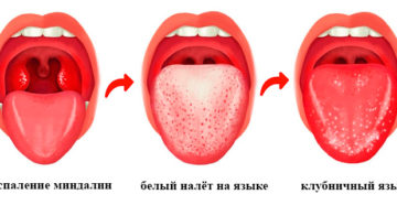 Белый налет на миндалинах и языке Белый налет на миндалинах и языке