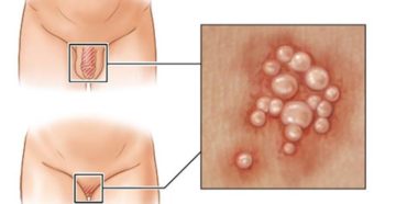 Ранки в виде порезов около влагалища