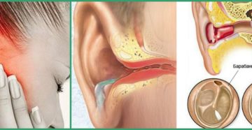 Посттравматический отит Посттравматический отит