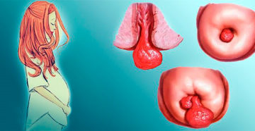 Децидуальный полип Децидуальный полип