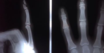Неправильно сросшийся краевой перелом основания ногтевой фаланги