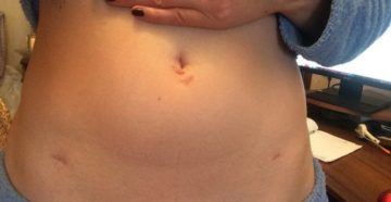 После лапароскопии