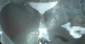 Не проходима одна маточная труба Не проходима одна маточная труба