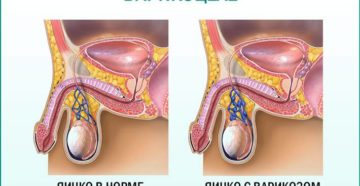 Возникновение варикоцеле от мастурбации