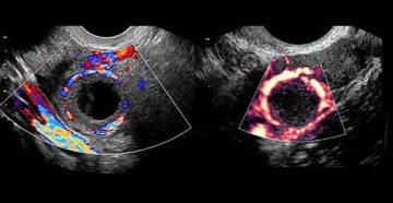 Желтое тело в трубе