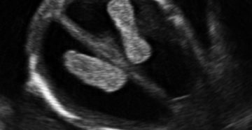 Вентрикуломегалия плода