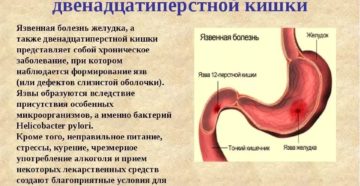 Лечение при язве двенадцатиперстной кишки