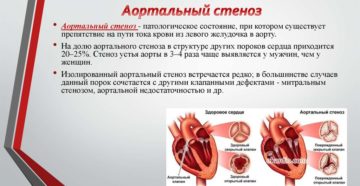 Склеротические изменения стенок МК, АОК.