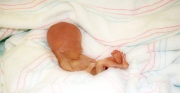 Прерывание беременности на 16-17 неделе беременности