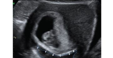 Отслойка плодного яйца 16х8мм