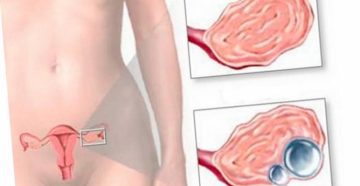 Болит в районе правого яичника