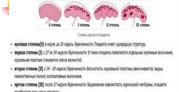 Старение плаценты на 28 неделе беременности