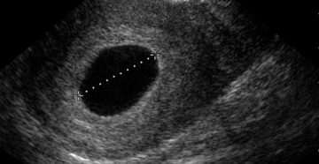 Анэмбриония?