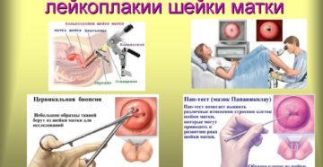 Лейкоплакия шейки матки, ваше мнение