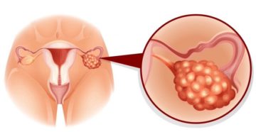 Киста яичника и витамины