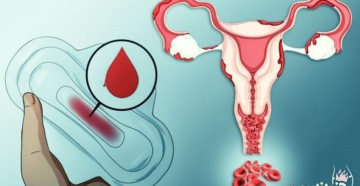 Кровянистые выделения при отсутствии матки